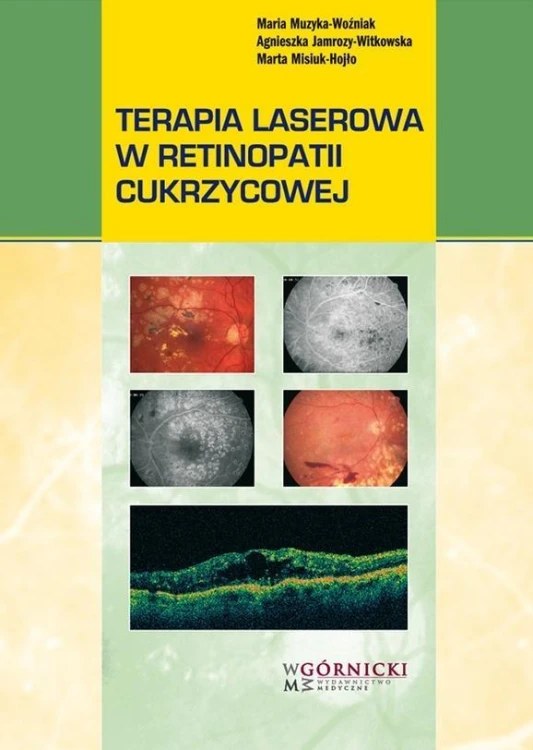 Terapia laserowa w retinopatii cukrzycowej